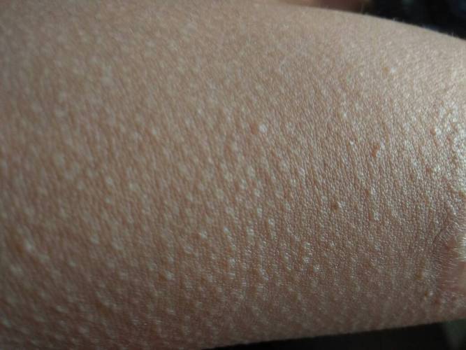 鸡皮肤,学名叫毛周角化症.