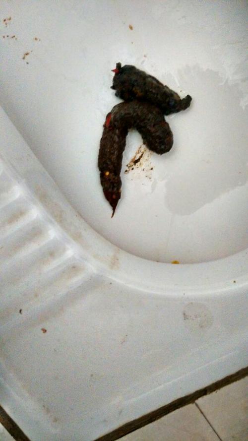 这个黑色粪便是不是胃癌的症状,黑便都好几年了,有时候就不黑了,吃饭