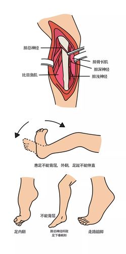 干货满满,肌肉萎缩与神经损伤的诊断