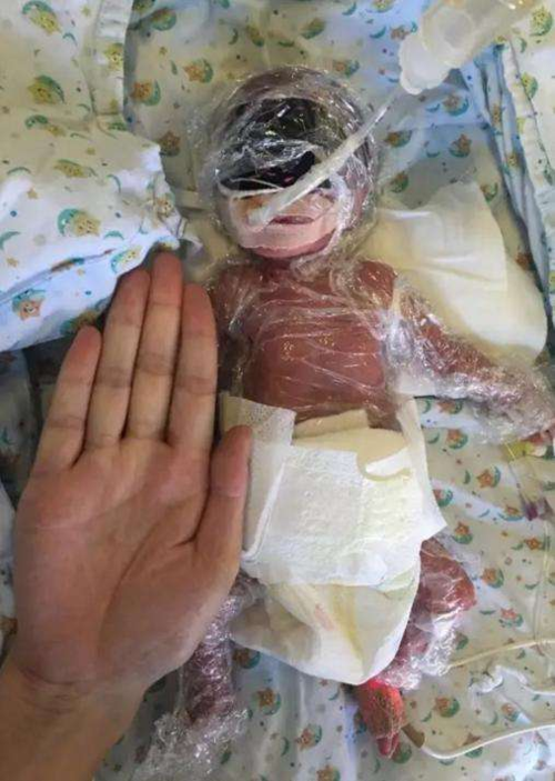 25周就出生的龙凤胎顺利度过难关,刚出生时才巴掌大小_手机搜狐网