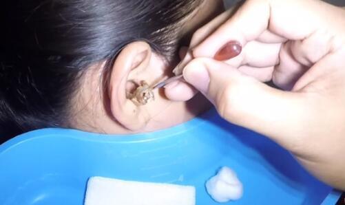 25年没挖耳屎 医生掏出后网友全跪了