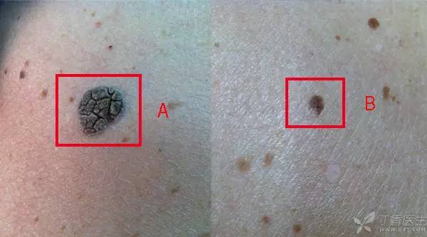 经过一番查看,医生稳住了老赵的心慌.医生说,这是「老年疣」.