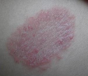 湿疹和癣有什么区别,专家为您解答