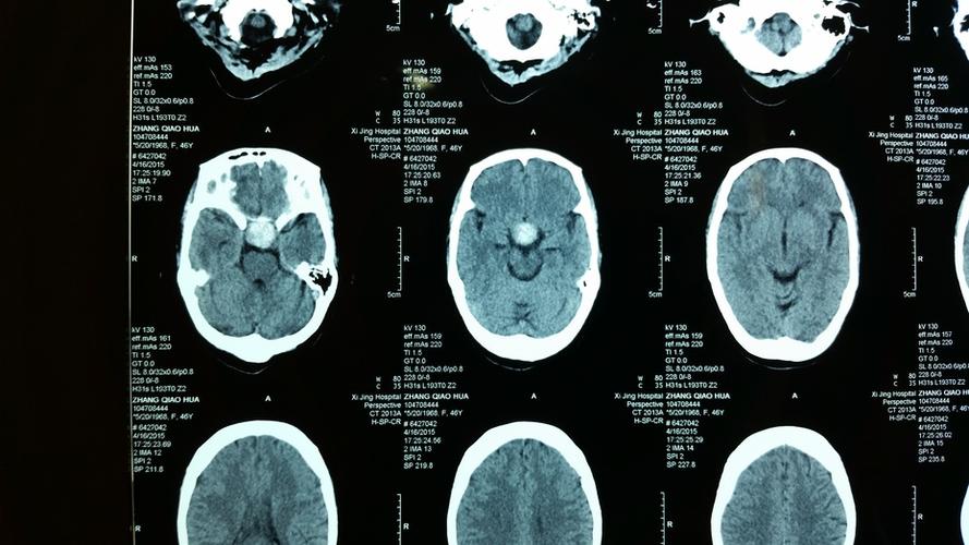 经检查ct:鞍区占位,密度混杂,鞍底骨质破坏,向蝶窦内发展  视力检查