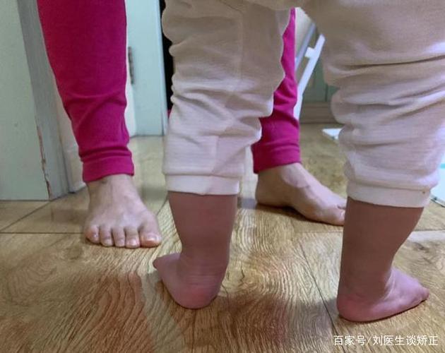 脚跟外翻偏斜