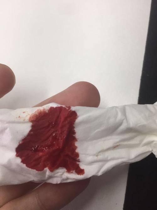 最近左边鼻子老是流鼻血咋办?