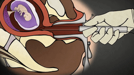 3分钟"无痛人流",剥夺的可能是你一辈子当妈妈的权利!