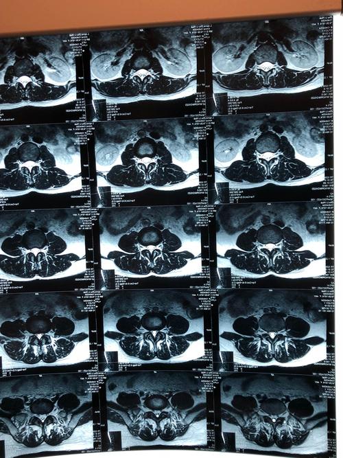 腰椎mr水平切面,无明显椎间盘压迫神经根情况