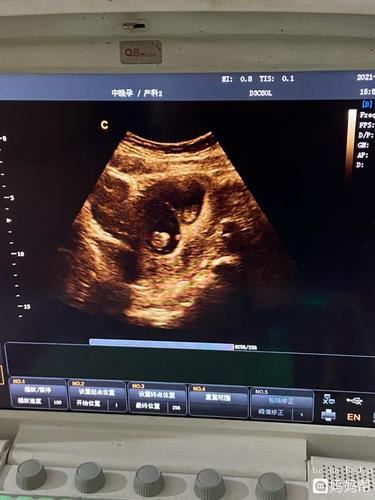 今天b超检查说是双胞胎 但相差一个星期