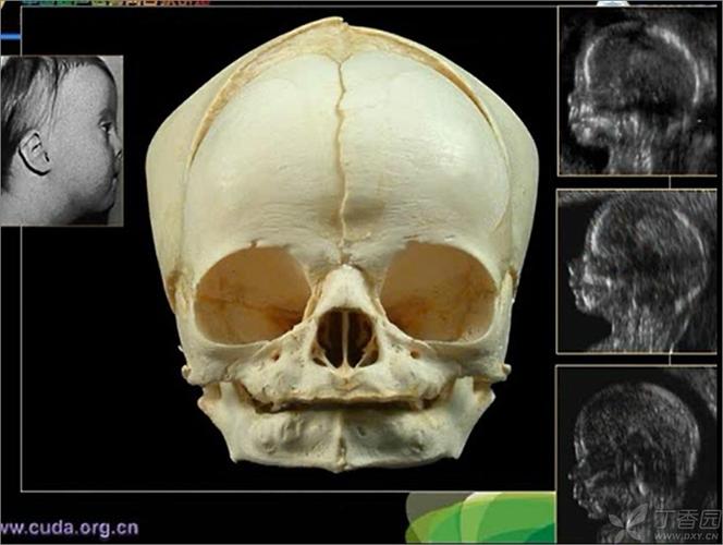 胎儿鼻骨发育