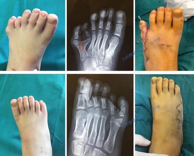 第五足趾多趾的治疗_先天性足畸形 - 好大夫在线