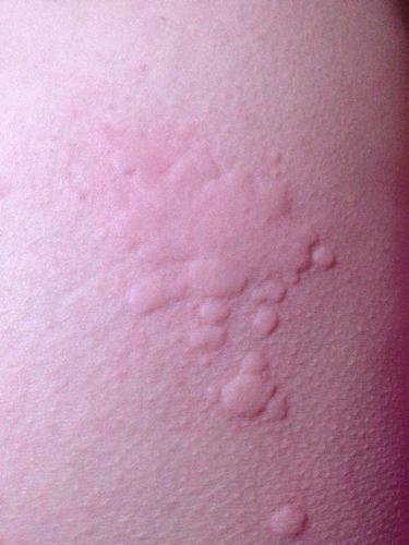 身上起了好多这样的疙瘩 很痒 前几天感冒了 吃了感治愈胶囊 但是吃多