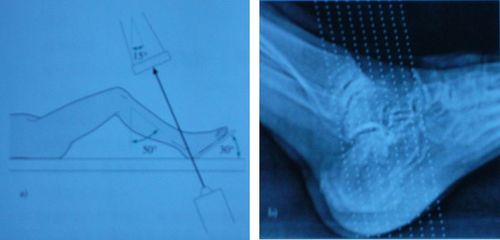 骨科基础 | 跟骨骨折手术治疗的要点及技巧