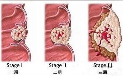 【科普】息肉痔