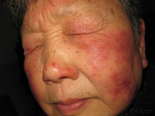 看图识病--------------多形红斑?
