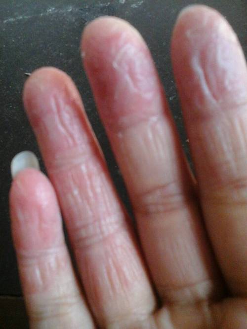 手指头指腹湿疹严重,一层一层脱皮干裂有什么最好的治疗方法