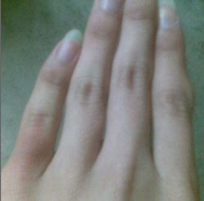 手指上长了瘤状物