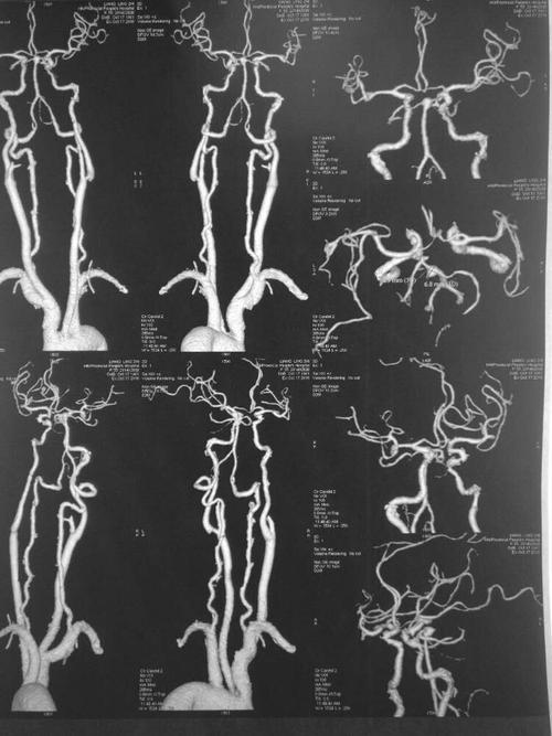 这是cta看到的头颈部血管的全观图