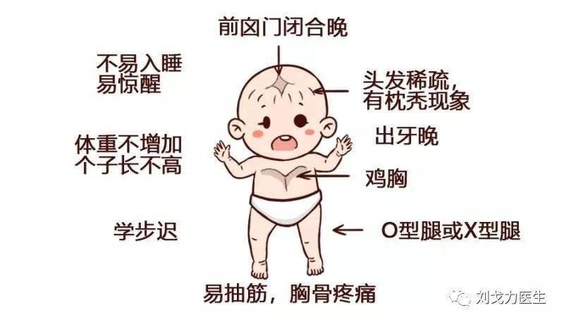 佝偻病是幼婴儿时期的高发病,很多家长都不知道