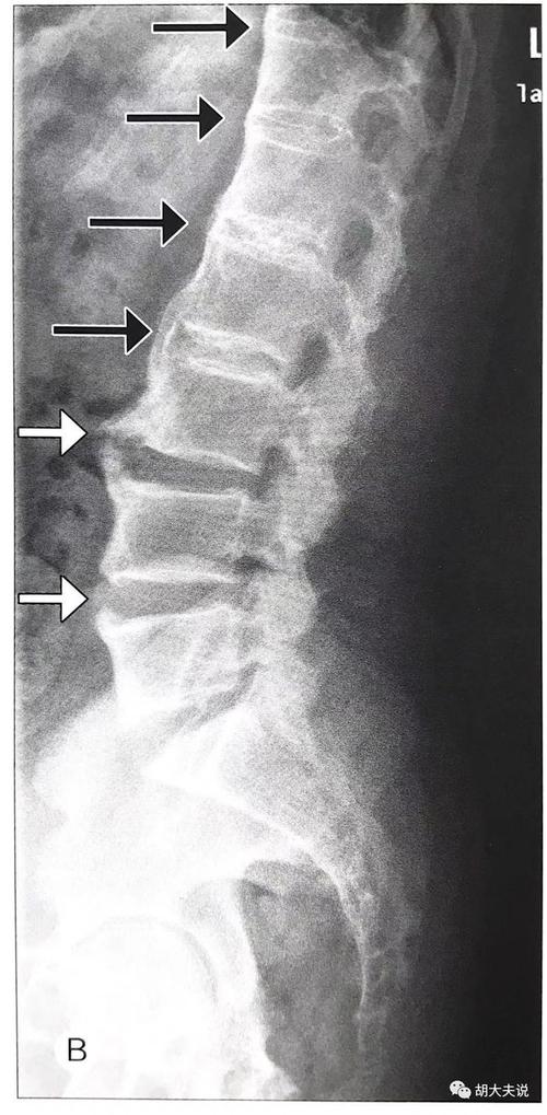 强直性脊柱炎骶髂关节ct分级和竹节样改变