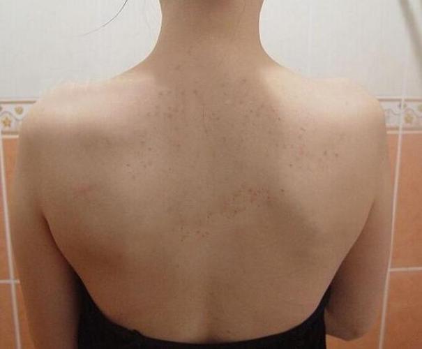 后背老长痘痘自以为是上火问题其实八成是螨虫作歹