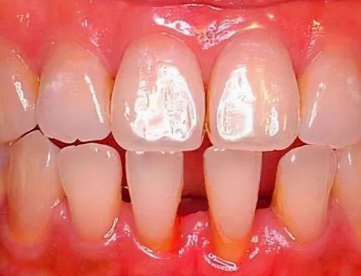 广州牙周炎和牙龈炎虽只是一字之差但区别很大