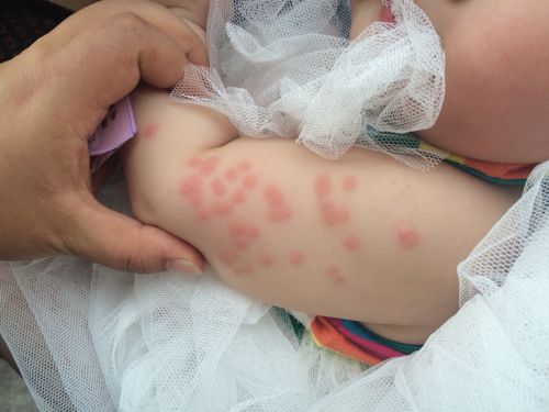 宝宝8个月,胳膊,大腿,脑后突然出了很多这样的红疙瘩