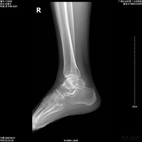 二例距骨病变,附ct