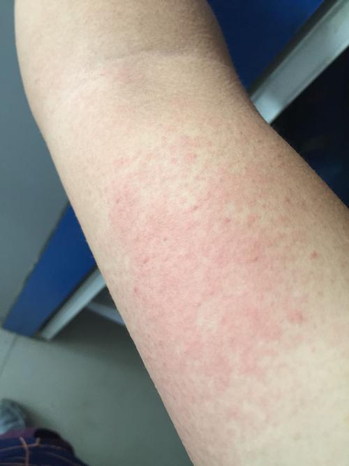 手臂全是这样的红点点 是被虫子咬了还是皮肤过敏