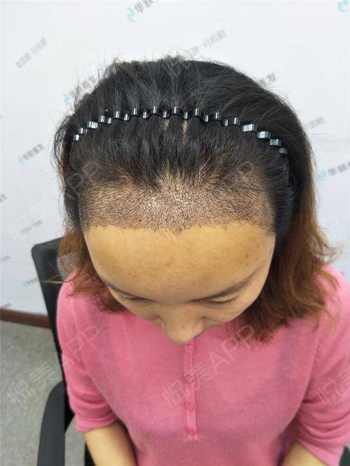 发际线四天的样子.