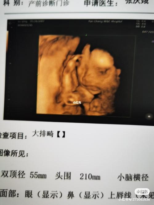 22周四维彩超顺利通过!感恩!