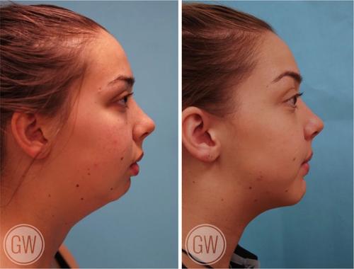 你脸圆可能不是因为胖,而是没下巴 (转载)