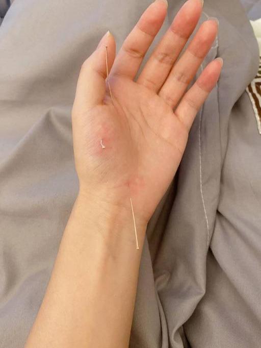 跳水名将何姿做保健保养身体拔罐放血针灸刺穿手掌太可怕