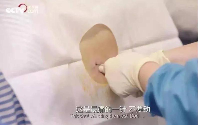 打无痛的时候,很粗的针头穿过她腰部的脊椎孔,然后有一根细小的导管会