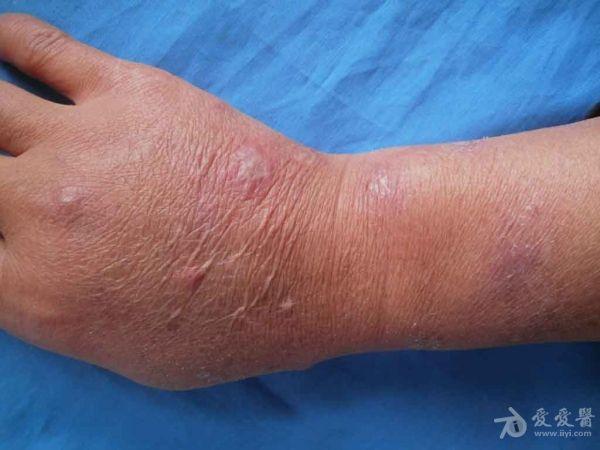 因"感冒"静点抗炎药物后,在静点皮肤处,出现红肿,毛囊炎改变,  问病史