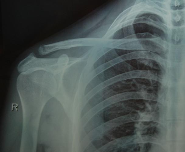 3月初骑车跌伤,导致右肩锁骨远端骨折,4月底拍x片右肩