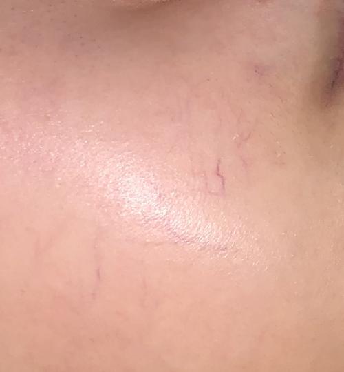 嘴角旁边的脸上有一片血管很明显