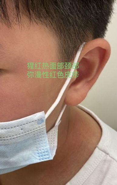 孩子发热咽痛起疹子,可能是猩红热|皮疹|风湿热|本病