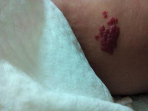 两个月的婴儿肚子右侧长有一个血管瘤,有图,请问是哪种类型的,该用哪