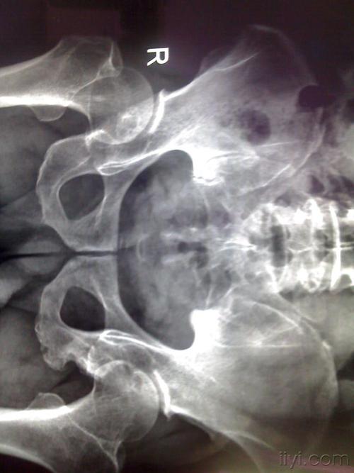 左侧坐骨病变,请教!