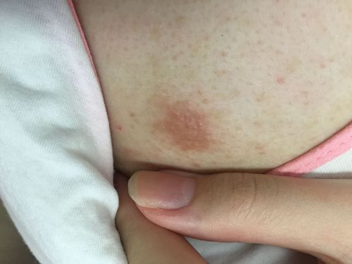 长在乳头附近,表面有点粗糙,油油的,会痒?请问用什么药好