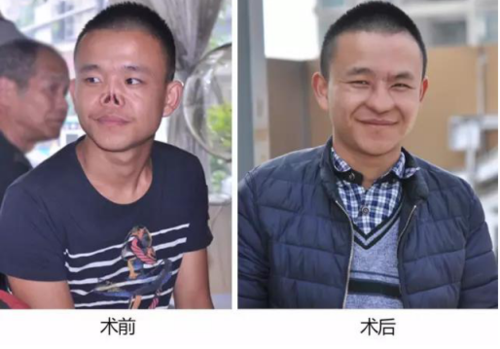 健康 > 正文   90后临沂女孩王红红,鼻骨缺失,软骨层坍塌,鼻部整体