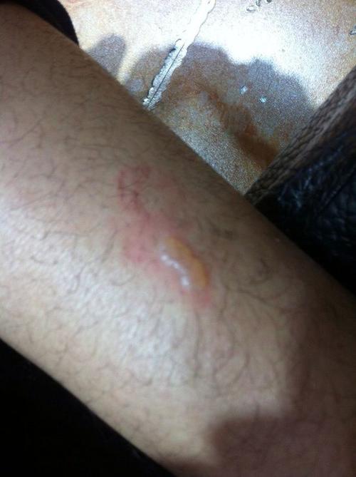 小腿长了个水泡是怎么回事