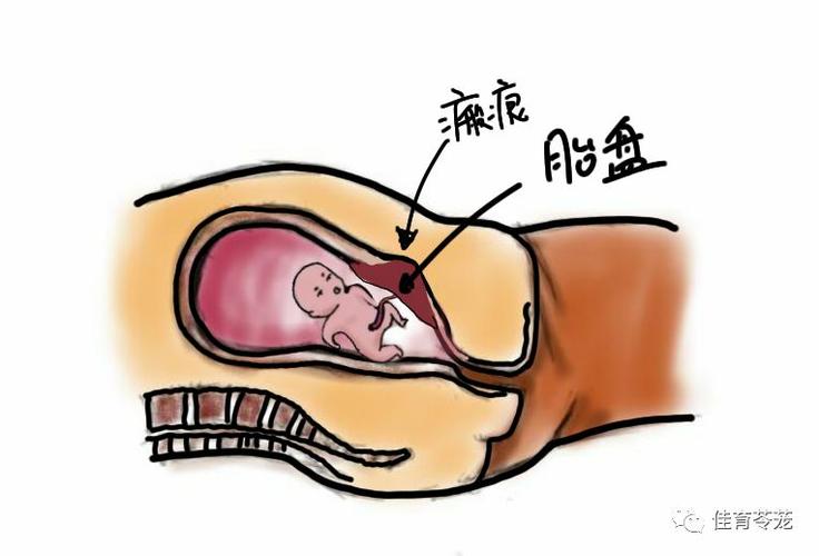 瘢痕妊娠——胚胎长在子宫瘢痕上,真的很可怕