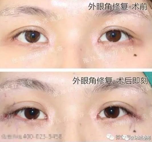 冰洁克莱美舍外眼角修复案例展示-张冰洁整形
