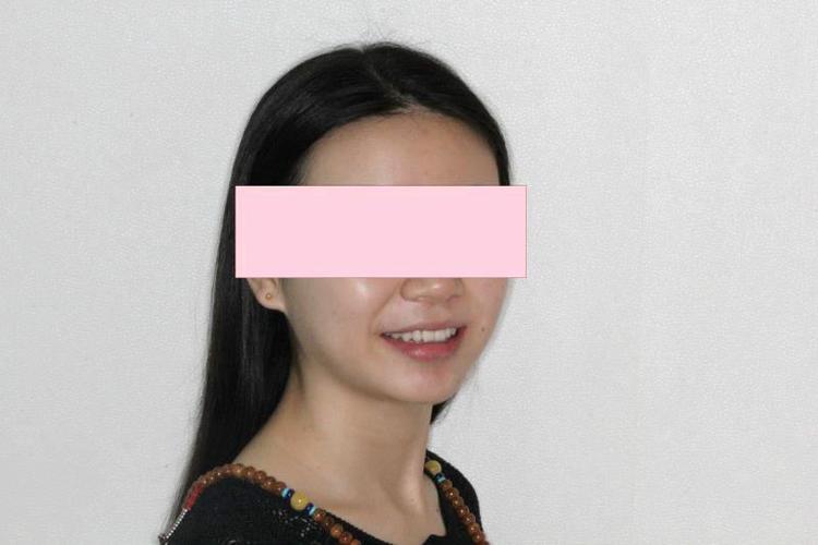 地包天女生矫正,13个月还你灿烂笑容!