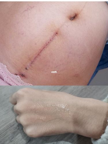 剖腹产竖切恢复更好?剖腹产妈妈要知道的_剖腹产_凝胶