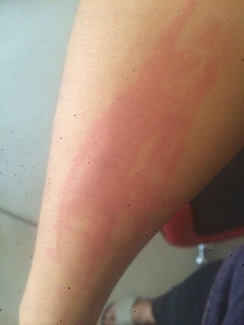 前几天皮肤过敏过,原因是穿一件刚买回来的新衣服,麻料的,现在疙瘩没