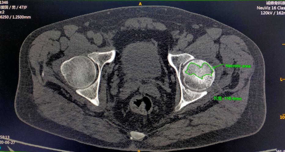 ct显示股骨头坏死区