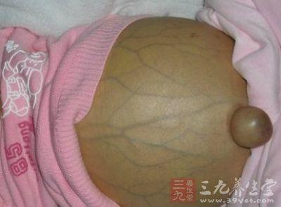 血吸虫性肝病的临床表现